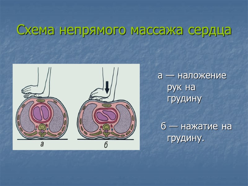 Схема непрямого массажа сердца   а — наложение рук на грудину  